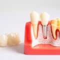 Implant zęba – co to jest?