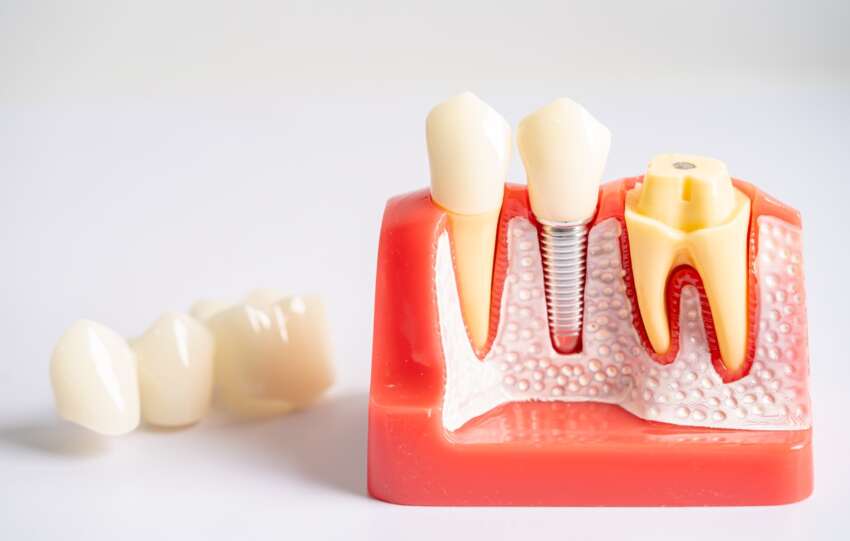 Implant zęba – co to jest?